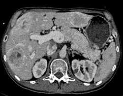 Islet Cell Tumor With Liver Metastases - CTisus CT Scan