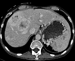 Islet Cell Tumor With Liver Metastases - CTisus CT Scan