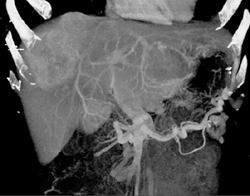 Islet Cell Tumor With Liver Metastases - CTisus CT Scan