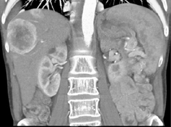 Islet Cell Tumor With Liver Metastases - CTisus CT Scan