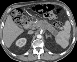 Pancreatic Cancer Encases the SMA and Portal Vein - CTisus CT Scan