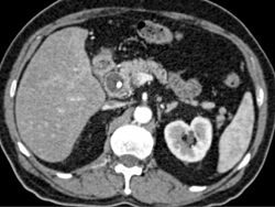 Dilated Common Bile Duct (CBD) With Neurogenic Mass in Ampulla - CTisus CT Scan