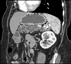 Intraductal Papillary Mucinous Neoplasm (IPMN) Replaces Entire Pancreas - CTisus CT Scan