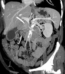 Pancreatic Cancer Encases the PV/SMV - CTisus CT Scan