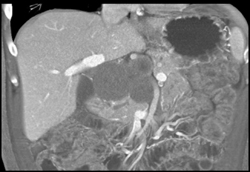 Cystadenoma - CTisus CT Scan