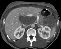 Cystadenoma - CTisus CT Scan