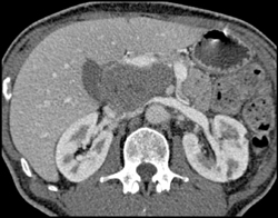 Cystadenoma - CTisus CT Scan