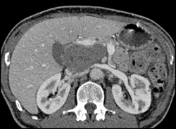 Cystadenoma - CTisus CT Scan