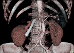 Stent in Common Bile Duct (CBD) in Patient With Unresectable Pancreatic Cancer Which Occludes the Portal Vein - CTisus CT Scan