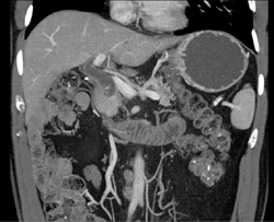 Pancreatic Cancer - CTisus CT Scan