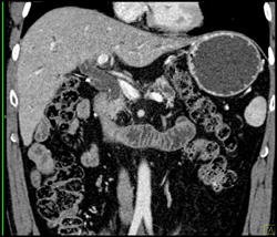 Pancreatic Cancer - CTisus CT Scan