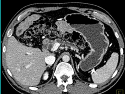 Encasement of Common Bile Duct (CBD) - CTisus CT Scan