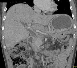 Pancreatic Cancer - CTisus CT Scan