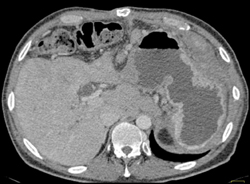 Pancreatic Cancer - CTisus CT Scan