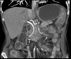 Pancreatic Cancer Encases the PV/SMV - CTisus CT Scan