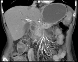 Pancreatic Cancer Encases the PV/SMV - CTisus CT Scan