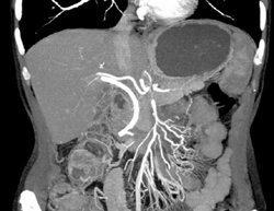 Pancreatic Cancer Encases the PV/SMV - CTisus CT Scan