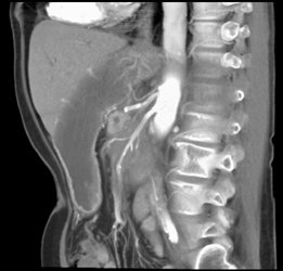 SMA Encasement By Pancreatic Cancer - CTisus CT Scan