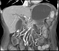 Encased SMA and PV Due to Pancreatic Cancer With Super Collaterals - CTisus CT Scan