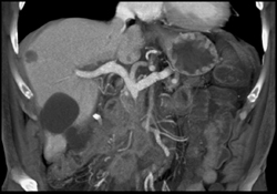 Encased PV/SMV Due to Pancreatic Adenocarcinoma - CTisus CT Scan