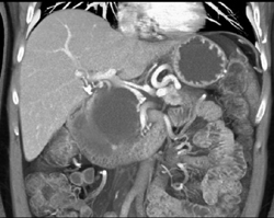 Cystadenoma - CTisus CT Scan