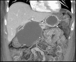 Cystadenoma - CTisus CT Scan