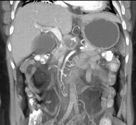 Encased Portal Vein (PV) With Dilated Gallbladder - CTisus CT Scan