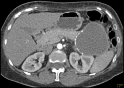 Calcified Cyst of the Pancreatic Tail - CTisus CT Scan