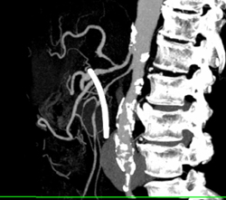 Encased SMA and Celiac Artery - CTisus CT Scan