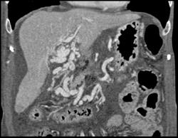 Pancreatic Cancer Encases Portal Vein With Cavernous Transformation of the Portal Vein (CTPV) - CTisus CT Scan