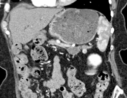 Small Adenoma - CTisus CT Scan