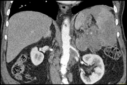 Pancreatic Tail Tumor - CTisus CT Scan