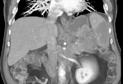 Pancreatic Cancer of the Tail Causes Splenic Infarction - CTisus CT Scan