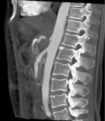 Celiac Encasement - CTisus CT Scan