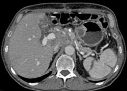 Pancreatic Cancer Encases the Portal Vein (PV) - CTisus CT Scan