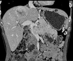 Islet Cell Tumor of the Pancreas Invades the Portal Vein-note Vascular Liver Metastases - CTisus CT Scan