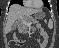 Cystic Pancreatic Mass-c/w Cystadenocarcinoma - CTisus CT Scan