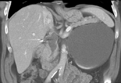 Dilated Common Bile Duct (CBD) With Stricture - CTisus CT Scan