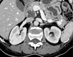 Intraductal Papillary Mucinous Neoplasm (IPMN) - CTisus CT Scan