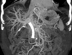 Stent in Common Bile Duct (CBD) for Pancreatic Cancer - CTisus CT Scan