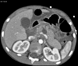 Pancreatic Laceration S/P Trauma - CTisus CT Scan