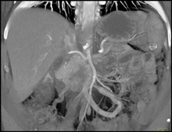 Pancreatic Cancer - CTisus CT Scan