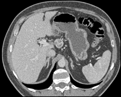 Pancreatic Cancer - CTisus CT Scan