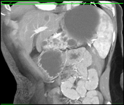 Multiple Intraductal Papillary Mucinous Neoplasms (IPMNs) - CTisus CT Scan