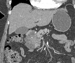 Cystadenoma of the Pancreas - CTisus CT Scan