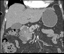 Cystadenoma of the Pancreas - CTisus CT Scan