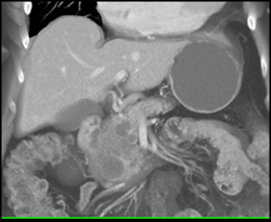 Cystadenoma of the Pancreas - CTisus CT Scan