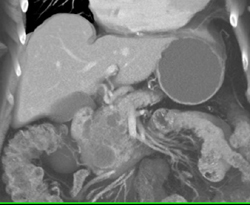 Cystadenoma of the Pancreas - CTisus CT Scan