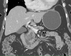 Cystadenoma of the Pancreas - CTisus CT Scan