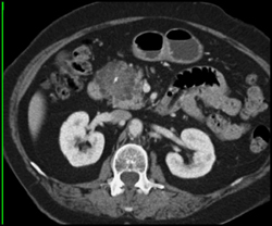 Cystadenoma of the Pancreas - CTisus CT Scan